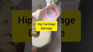 Hip Osteoarthritis Cartilage Thinning and Damage Model patienteducation [upl. by Paquito793]