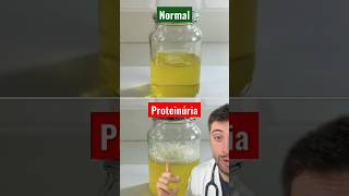 PROTEINÚRIA curiosidades curiosidademedicina medico medicina proteinuria rins [upl. by Ursel]