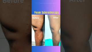 Treatment of varicose veins Foam Sclerotherapy treatment of varicose veins shorts varicoseveins [upl. by Leirud]