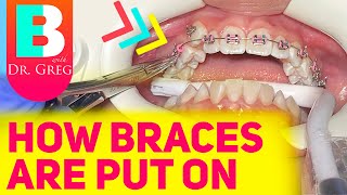 Getting Braces 101  Putting Braces On [upl. by Ettore]