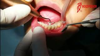 Tips of Periodontal Treatment Device P90 [upl. by Sewellyn21]