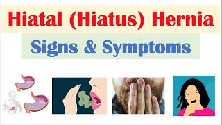 Hiatal Hiatus Hernia Signs amp Symptoms amp Why They Occur [upl. by Accebber599]