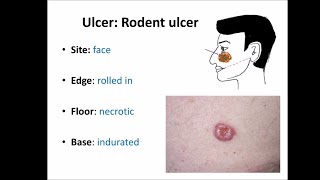 Basal cell carcinoma BCC [upl. by Townshend167]