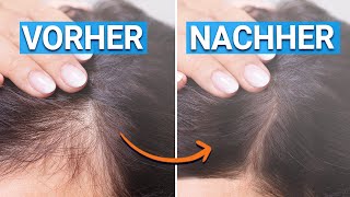 Haarausfall stoppen Mit diesen Tipps wachsen deine Haare wieder [upl. by Krik]