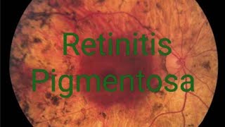 Retinitis pigmentosa RP treatment signs symptoms discussion  Simple version [upl. by Stauder]