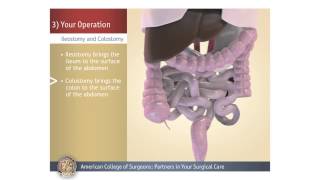 ColostomyIleostomy Your Operation [upl. by Peh13]