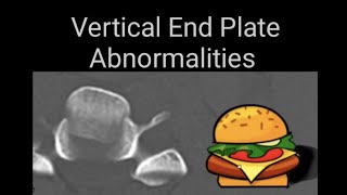 Vertibral end plates abnormalities on lumbosacral spine x rays and CT images [upl. by Madancy]