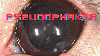 Pseudophakia  Artephakia  Ophthalmology Lecture [upl. by Aramit]