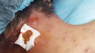 Extract Acne in Nape  HHV Clinic [upl. by Beberg581]