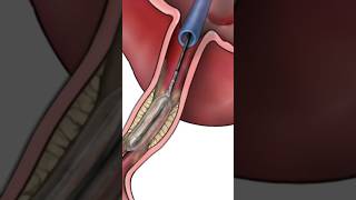 Coronary Angioplasty with Stent Placement  a minimally invasive procedure to improve blood flow [upl. by Aicatsan179]