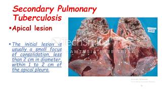 Secondary Pulmonary Tuberculosis [upl. by Eicyaj790]