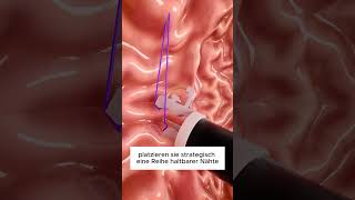 So funktioniert eine Magenverkleinerungsoperation 🤔 [upl. by Hamo]