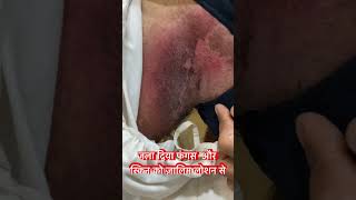 Fungal Skin Treatment India [upl. by Tooley]