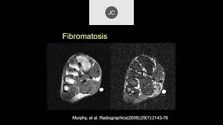 MRI of Soft Tissue Tumors  Part 2 [upl. by Benenson]