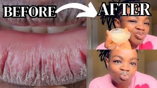 How to Get Rid of CHAPPEDDRY and CRACKED Lips FAST [upl. by Gitlow918]