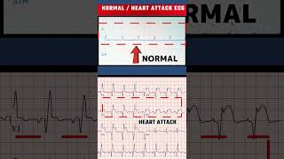 हार्ट अटैक का ECG  HEART ATTACK ECG VS NORMAL ECGshorts [upl. by Nwonknu]