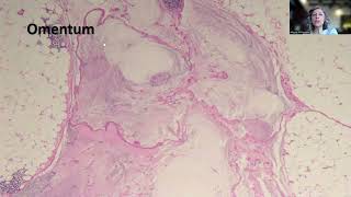 Tip85Lowgrade Appendiceal Mucinous Neoplasm LAMN [upl. by Grishilde571]