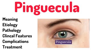 Pinguecula Conjunctival Anomalypinguecula eyes optometrists optometry [upl. by Aneelad926]