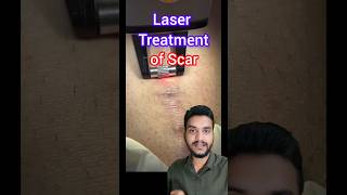 Laser treatment Keloid scar shorts [upl. by Soll]