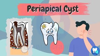 Periapical  Radicular Cyst  Oral pathology  Dental lectures [upl. by Eittap]