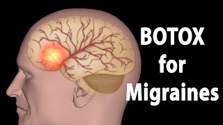 BOTOX for Migraines Animation [upl. by Aneela]