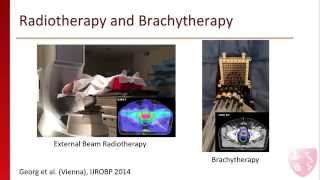 Brachytherapy for Intermediate and HighRisk Prostate Cancer [upl. by Niai]