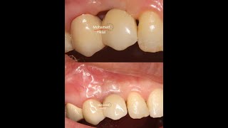 RECONSTRUCTION OF LOST INTERDENTAL PAPILLA  Black triangle treatment  Minimally invasive surgery [upl. by Naes]