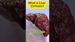 Liver Cirrhosis What You Need to Know livercirrhosis liverhealth acnnlifearena shortvideo [upl. by Arev686]