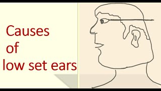 low set ears causes [upl. by Kirbee]