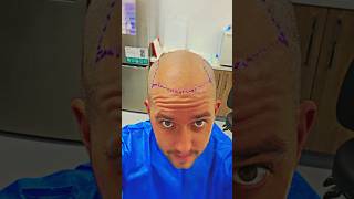 Best Hair Transplant In Australia Dr Ruk [upl. by Wynny813]