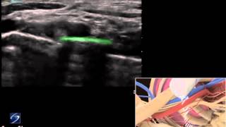 3D How To Ultrasound Guided Supraclavicular Nerve Block  SonoSite Ultrasound [upl. by Notsur572]