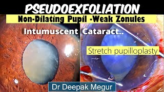 Phacoemulsification PseudoexfoliationPoor Mydriasis Weak Zonules Intumescent Cataract Dr Megur [upl. by Ayanej]