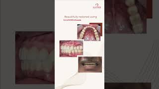 Dr Varun Mehra restored a missing premolar using an Illusion Zirconia Dental Crown🦷 [upl. by Arem]