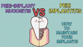 Peri Implant Mucositis vs PeriImplantitis  HOW TO MAINTAIN YOUR DENTAL IMPLANTS [upl. by Anilatak]