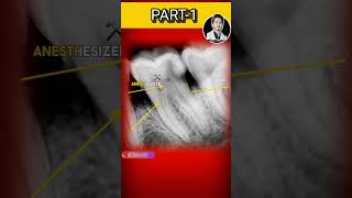 S1 SEPARATED in MESIOLINGUAL Canaldentist dentaltreatment rootcanaltreatment endodontics shorts [upl. by Lynch357]