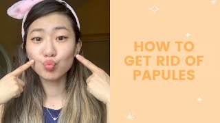 How to Get Rid of Papules  FaceTory [upl. by Saidee]