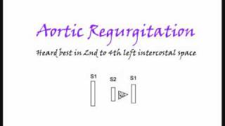 Aortic regurgitation heart murmur [upl. by Hteboj]