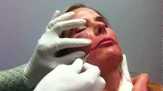 Blunt Cannula technique for lip enhancement Aesthetic Clinique Steve Weiner MD Destin [upl. by Afinom]