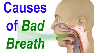 Sources of Bad Breath or Halitosis Evaluate Diagnose and Treat [upl. by Bowers]