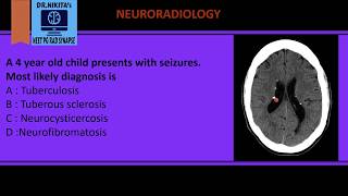 Tuberous sclerosis Neuroradiology [upl. by Narak784]