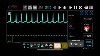 Supraventricular Tachycardia SVT Synchronised Cardioversion [upl. by Yoc]