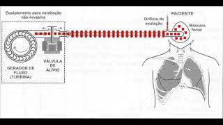 Ventilação Não Invasiva Bipap [upl. by Ettelocin]