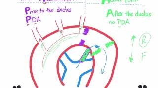 Coarctation of aorta Infantile type vs adult type mnemonic [upl. by Abrahan]