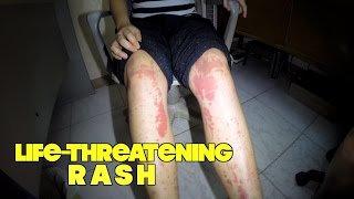 A lifethreatening rash [upl. by Jannel]