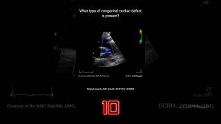 Echocardiography Question 18 [upl. by Anneirb]