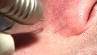 Dual Yellow laser  Facial telangiectasia 2  NORSELD  Thierry Rougeron  througeronyahoofr [upl. by Mulvihill]