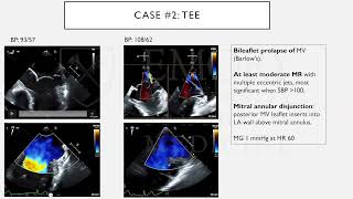 Mitral Valve Prolapse [upl. by Ziladnerb]