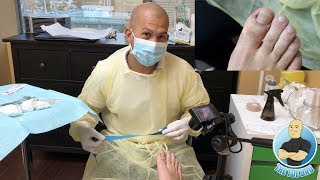 INGROWN TOENAIL SURGERY  How To Remove An Ingrown Toenail Forever POV [upl. by Nirra]