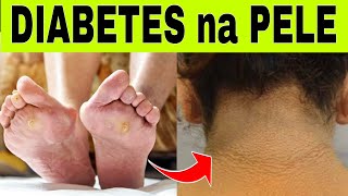 9 SINAIS de DIABETES na PELE [upl. by Hodgkinson]