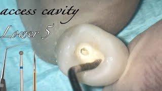 lower premolar access cavity preparation [upl. by Mattias]